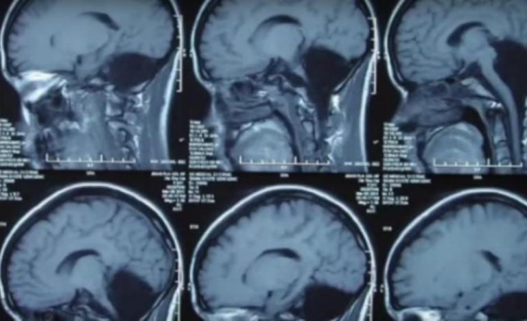 Научниците за прв пат скенираа мозок на маж кој бил на смртна постела – за прв пат научно објаснување што гледа човекот кога умира